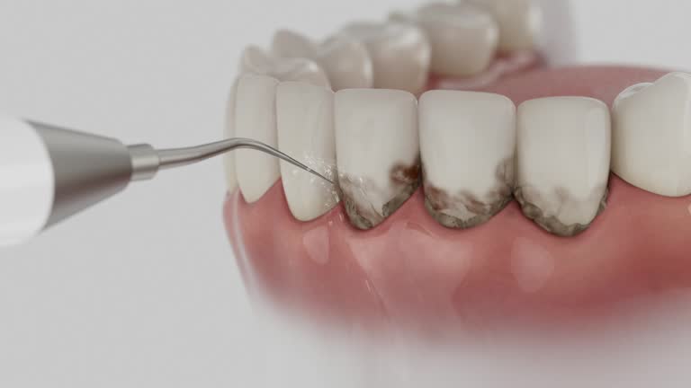 Trusted Wisdom Tooth Removal service in Bluefield, WV - Dentist Open Now
